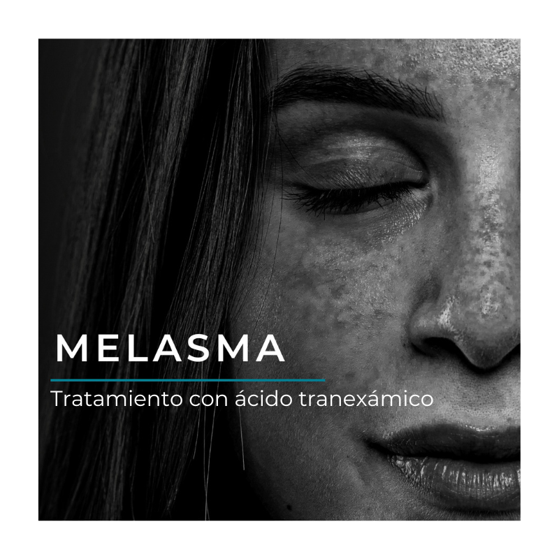Conozca todo acerca del tratamiento del melasma con ácido tranexámico