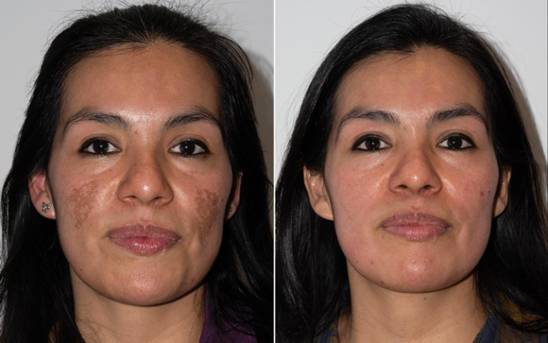 Conozca Todo Acerca Del Tratamiento Del Melasma Con ácido Tranexámico